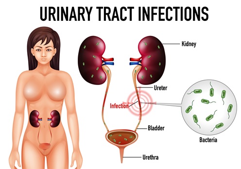 Urinary Tract Infection