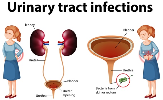 Urinary Tract Infection