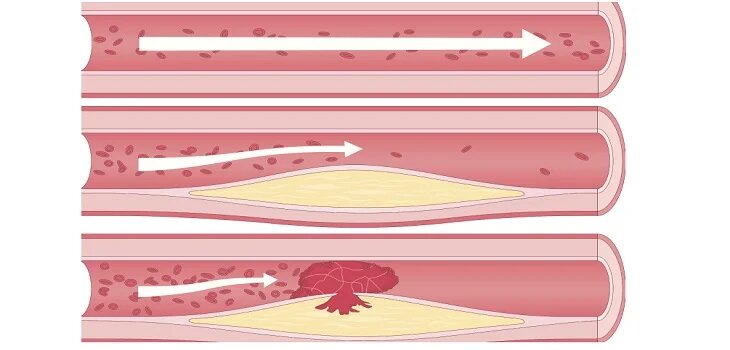 Ayurvedic Treatment for Atherosclerosis in Abohar