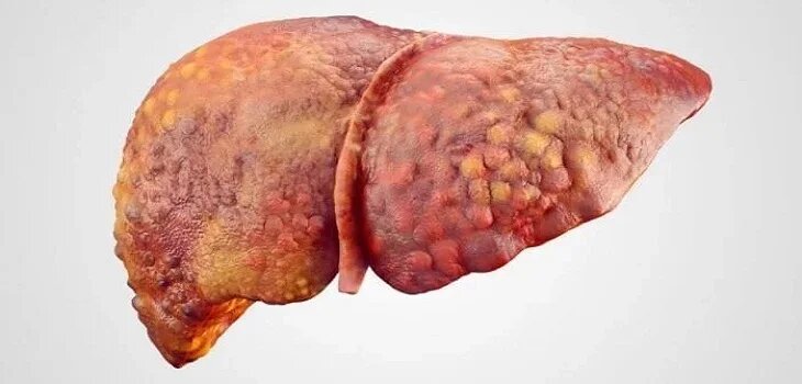 Ayurvedic Treatment for Cirrhosis of Liver in Accra