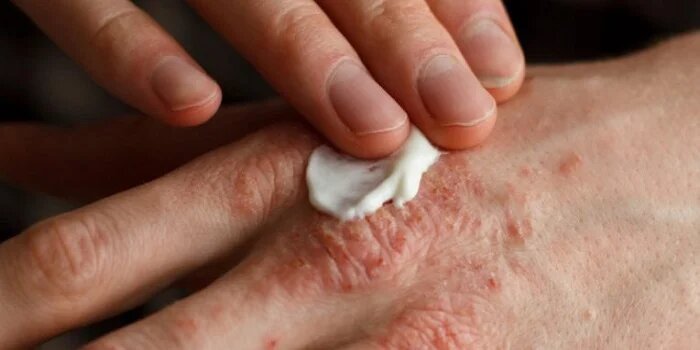 Ayurvedic Treatment for psoriasis in Airdrie