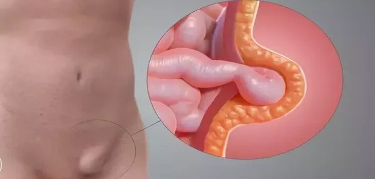 Ayurvedic Treatment for Hernia in Ghaziabad
