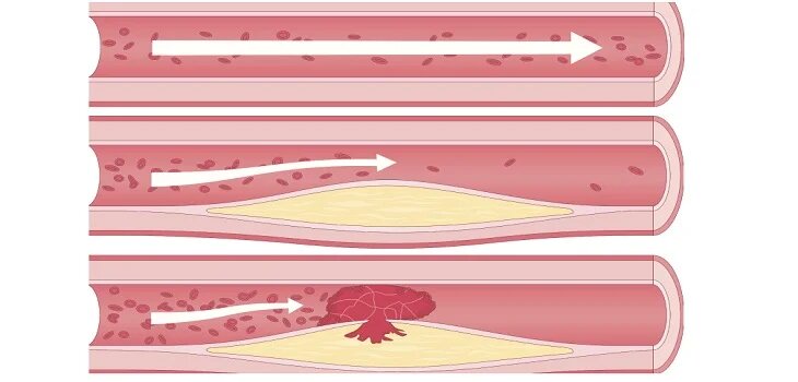 Ayurvedic Treatment for Atherosclerosis in Hooghly