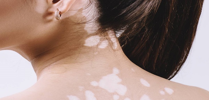 Ayurvedic Treatment for Leucoderma in Kumamoto