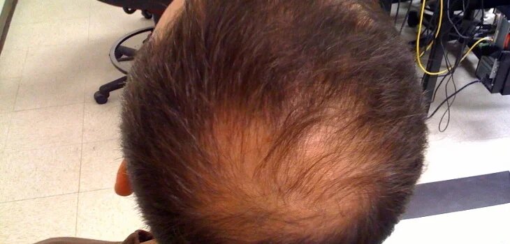 Ayurvedic Treatment for Hair Problems in Mehraj