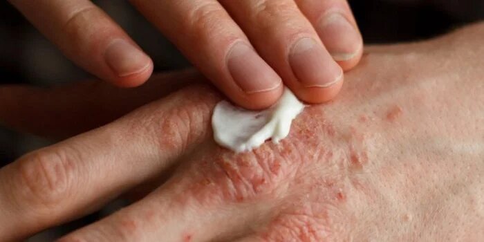 Ayurvedic Treatment for psoriasis in Mississauga