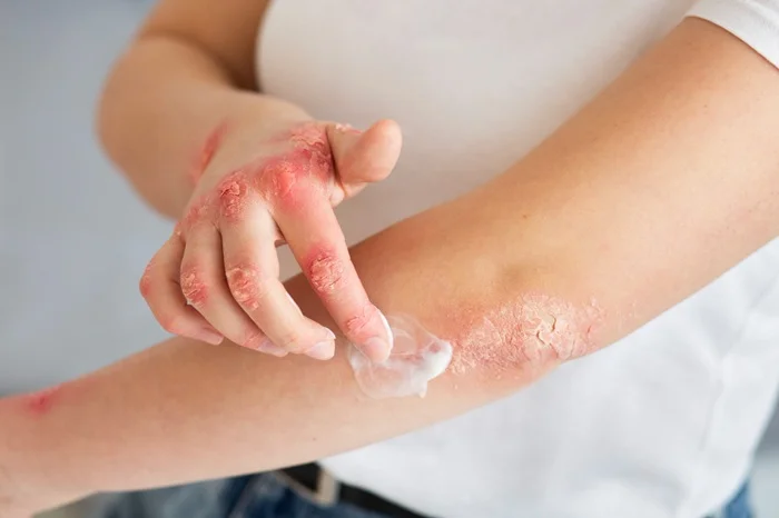 Psoriatic Arthritis