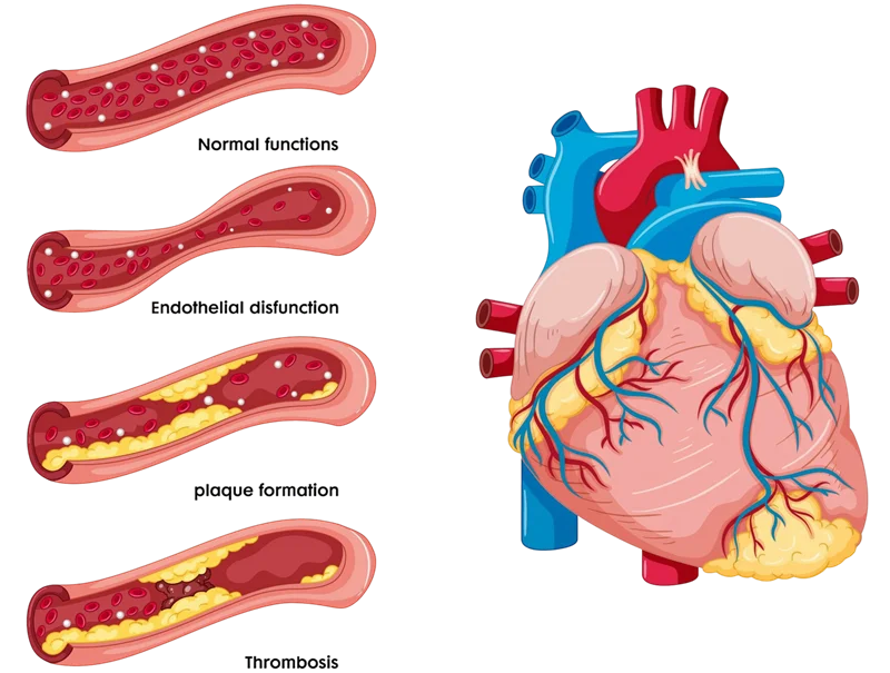 What is Atherosclerosis? What is Atherosclerosis?
