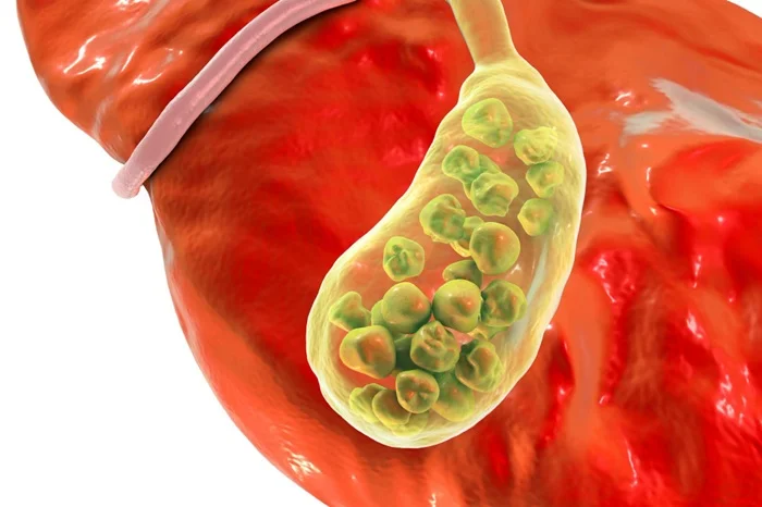 Gallstones Gallstones