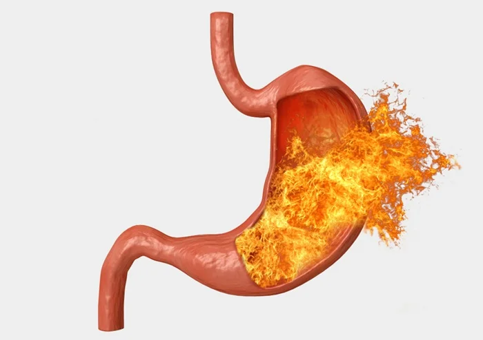 Gastritis Gastritis