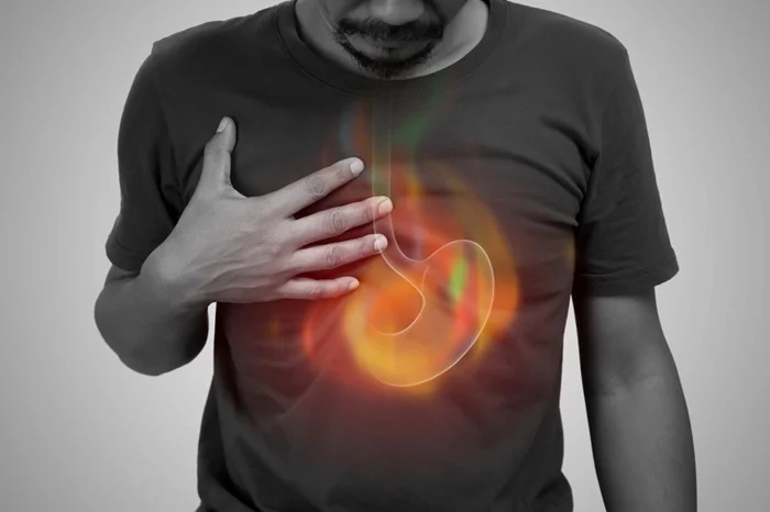 Gastro-oesophageal Reflux Disease (GERD) Gastro-oesophageal Reflux Disease (GERD)