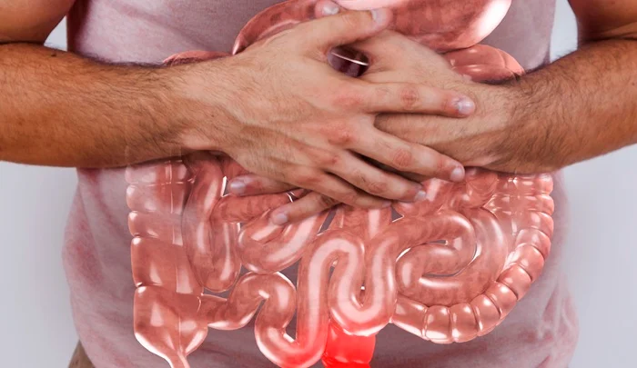 Inflammatory Bowel Disease (IBD) Inflammatory Bowel Disease (IBD)