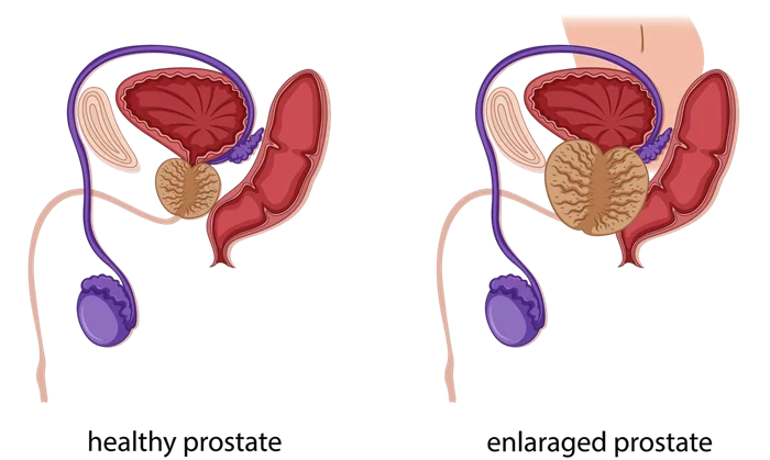 What is Enlarged Prostate?