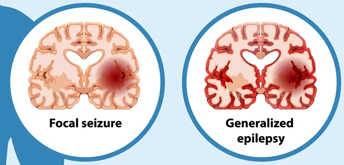 Combined Generalized & Focal Epilepsy