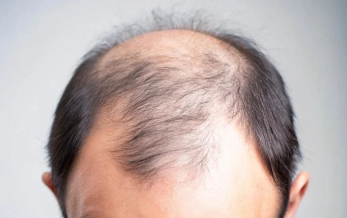 Alopecia Areata