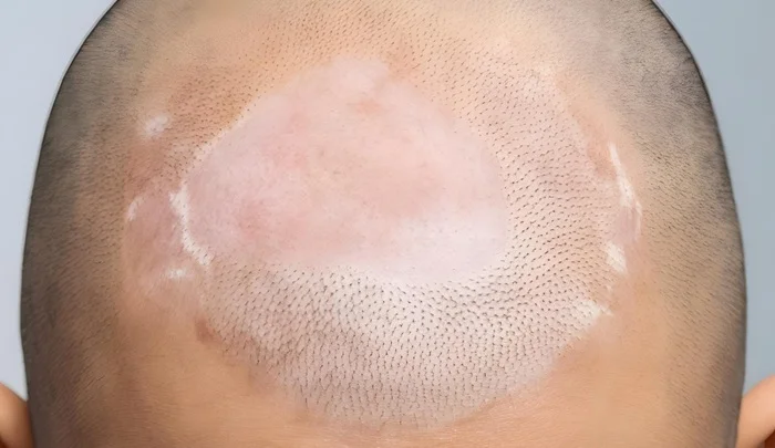 Cicatricial Alopecia Cicatricial Alopecia