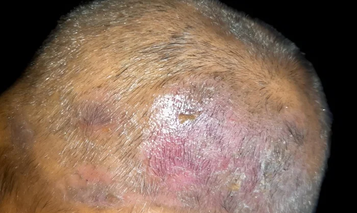 Tinea Capitis Tinea Capitis