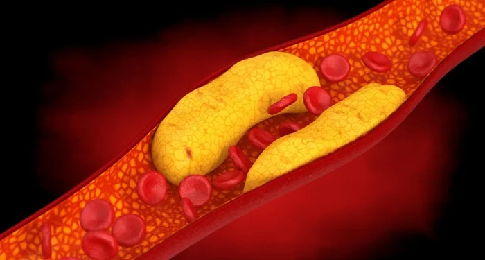 Low-Density Lipoprotein (LDL)