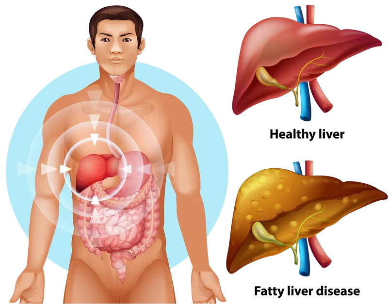 What is Liver Cirrhosis?