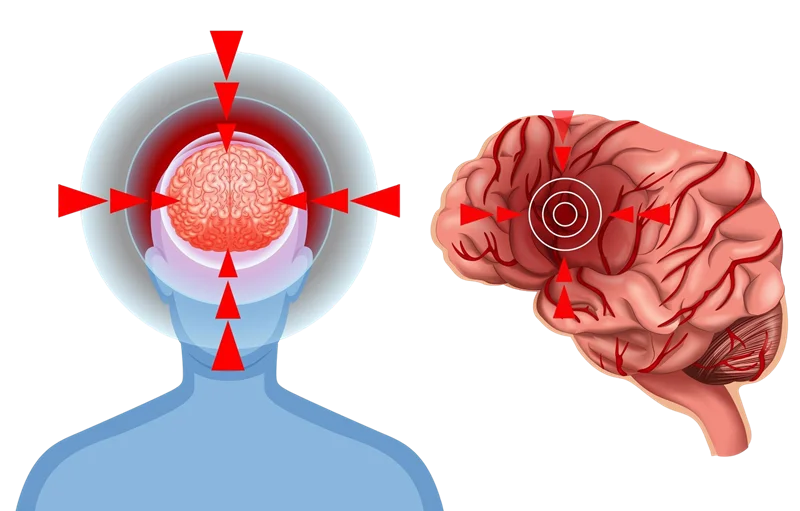 What is a Migraine?