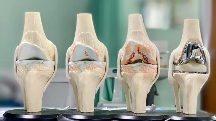 Secondary Osteoporosis