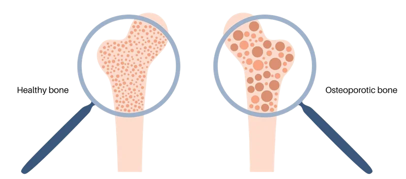 What is Osteoporosis?