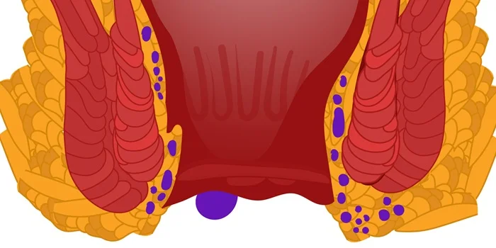 External Haemorrhoids