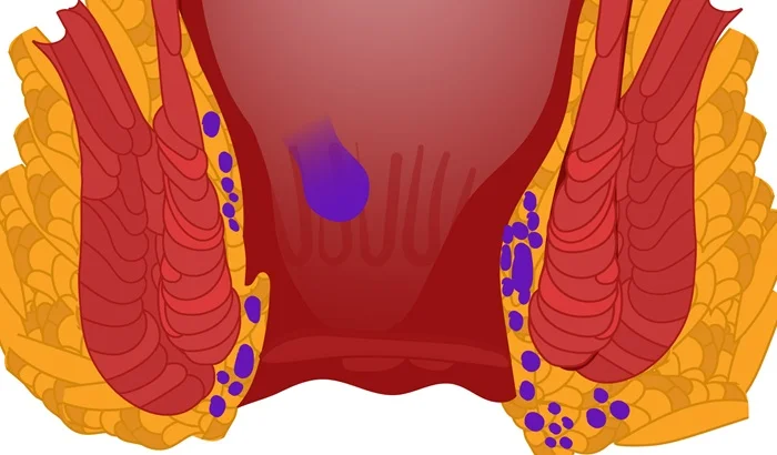 Internal Haemorrhoids