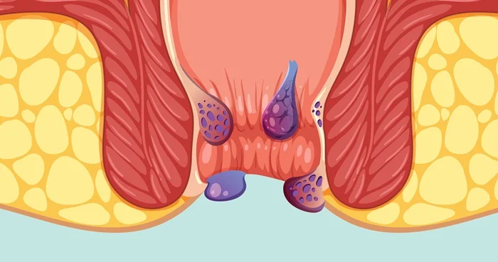 Mixed Haemorrhoids