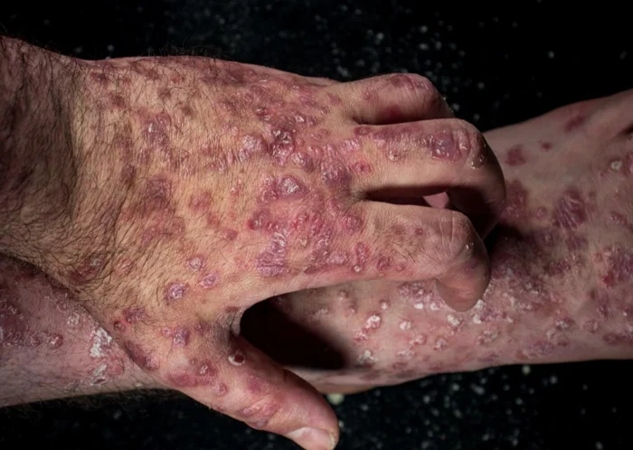 Guttate Psoriasis