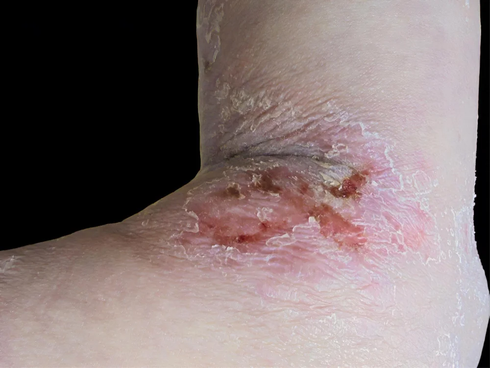 Inverse Psoriasis