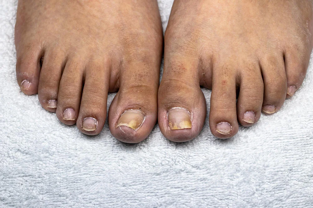 Nail Psoriasis