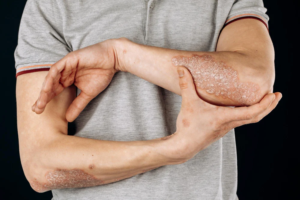 Plaque Psoriasis
