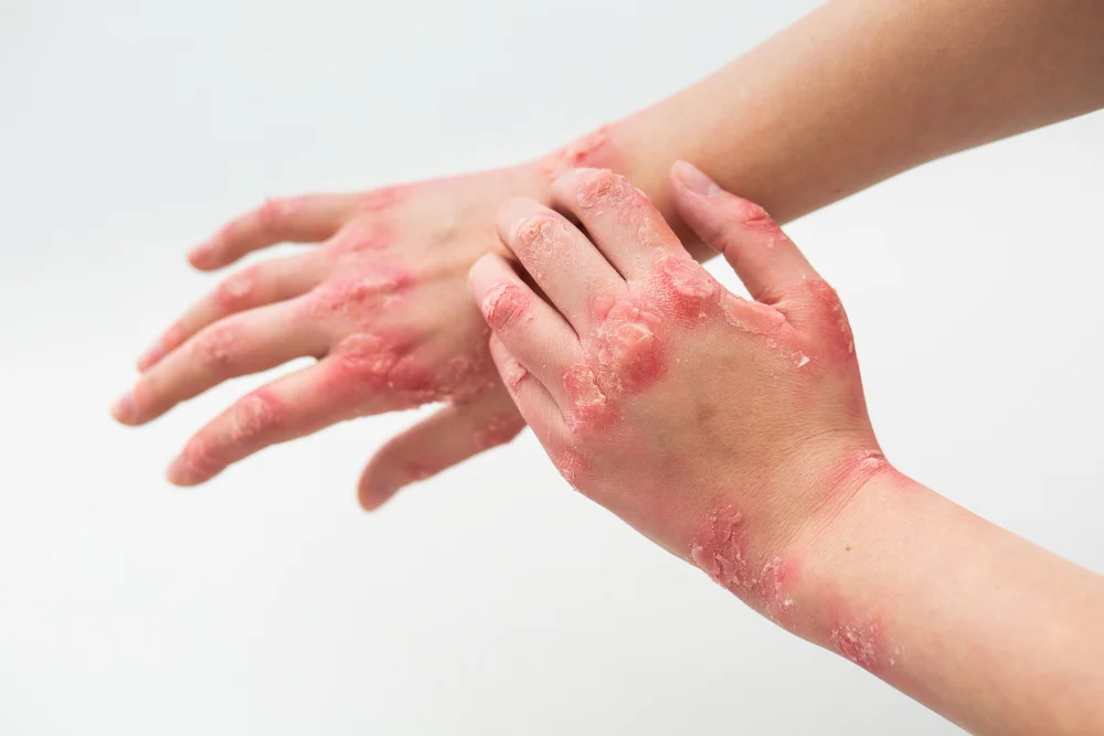 Ayurvedic Treatment for Psoriasis in Red-Deer