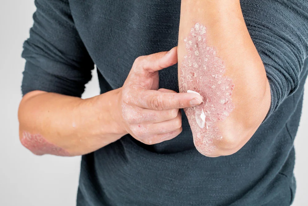 Pustular Psoriasis