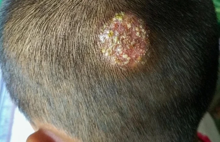 Seborrheic psoriasis