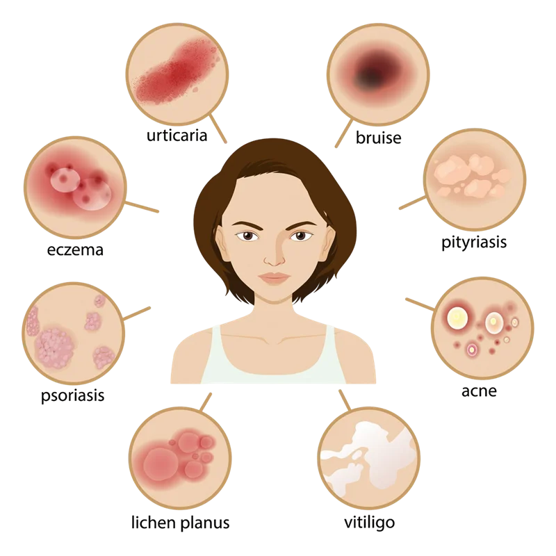 What is Psoriasis?