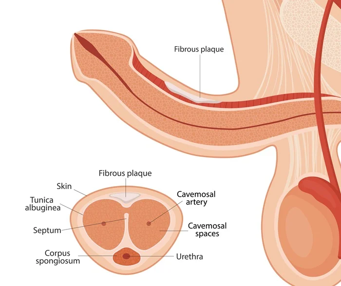 Peyronie’s Disease