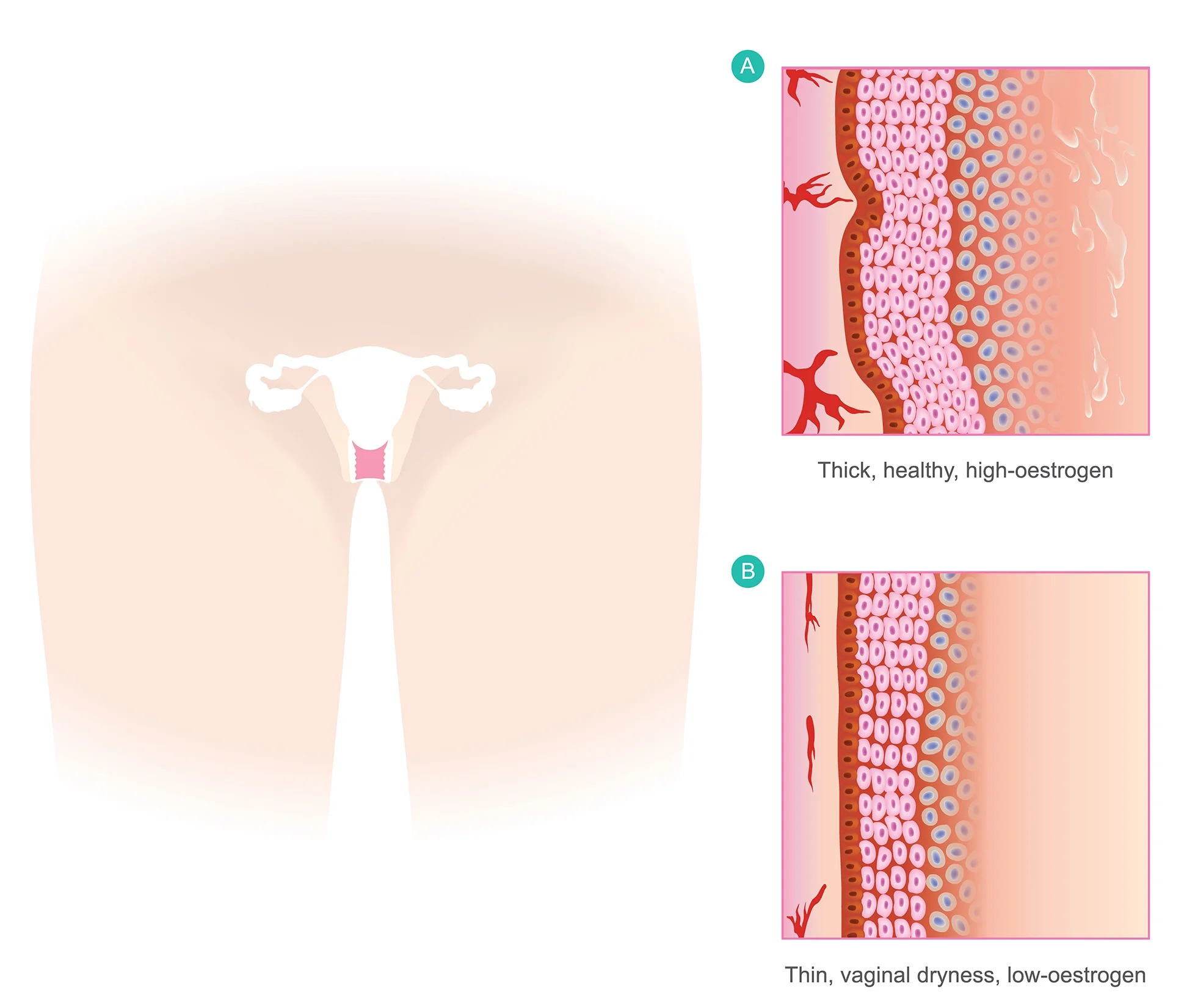 Vaginal Dryness