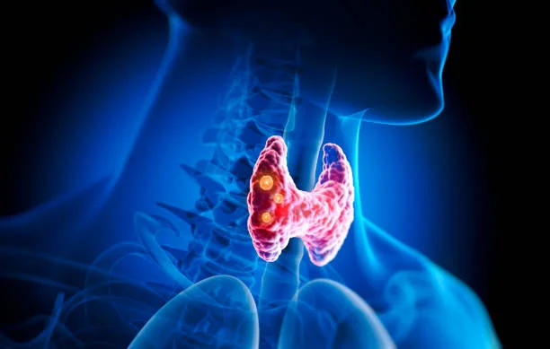 Hyperthyroidism