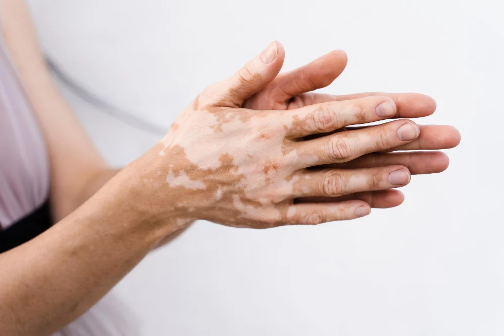 Ayurvedic Treatment for Vitiligo At Arogyadham Health & Wellness in Yokohama