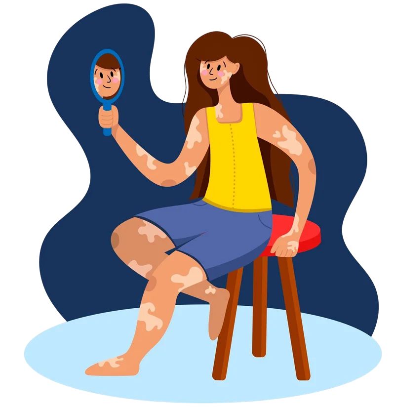 What Is Vitiligo & leucoderma?